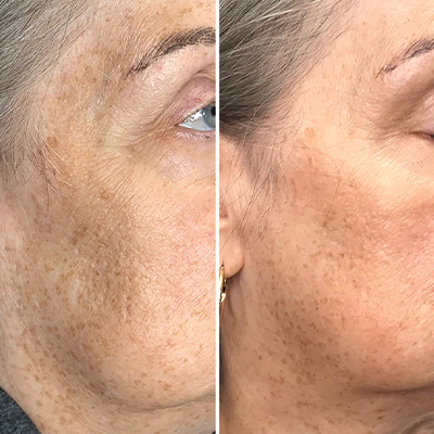 Plaxel Plasma Facial